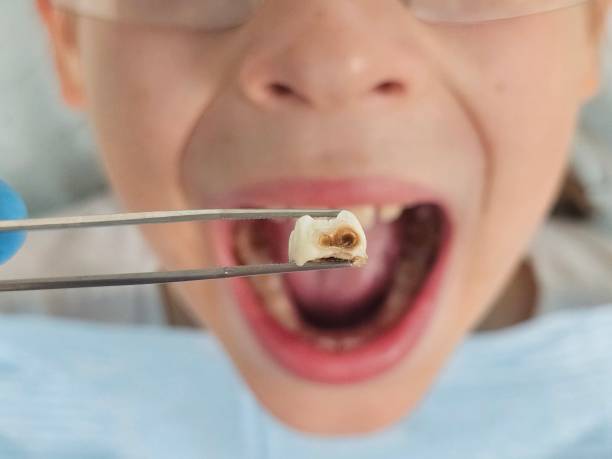 Best Emergency Broken Tooth Repair in Lakewood, IL